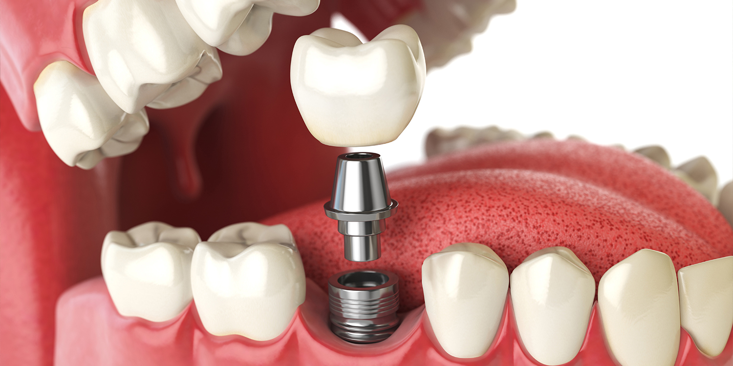 歯を失ってしまった方への治療法